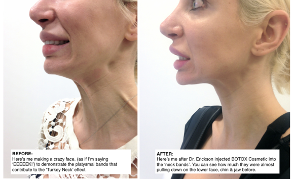 Nefertiti lift with BOTOX Cosmetic by Dr Quenby Erickson in Chicago