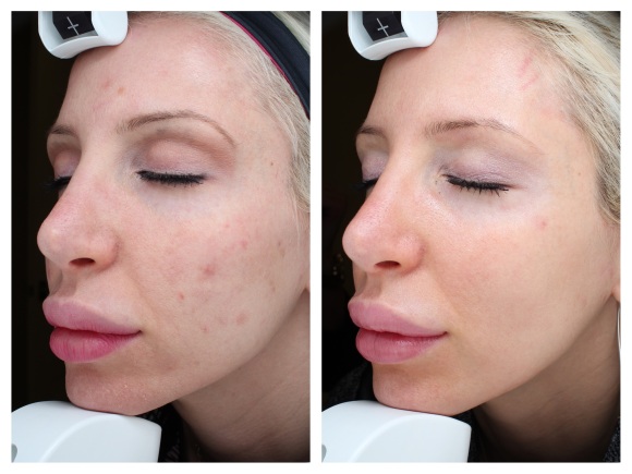 TheProductPro Before and After Photos Halo Laser